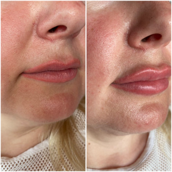 Заполнена носогубная морщина, морщина марионетка, увеличены 