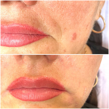 Коррекция носогубной складки. Канюля