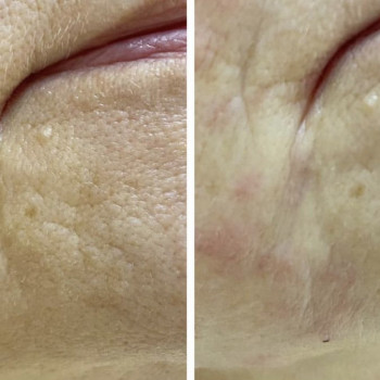 Заполнена морщина- марионетка. Игла