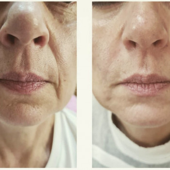 Комплексная коррекция канюлей нижней и средней трети лица- н