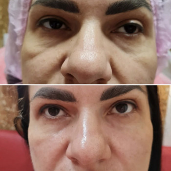 Коррекция носослезной борозды канюлей. Фото сразу «после»