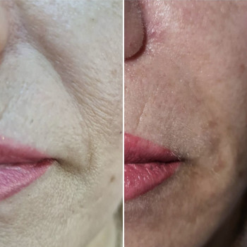 Носогубные складки канюля+ игла