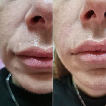 Носогубные складки канюлей