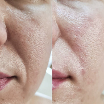 Носогубные складки канюлей