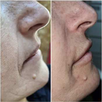 Носогубные складки канюлей