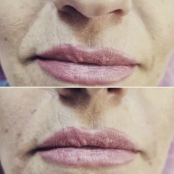 Носогубные складки иглой