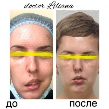 догляд за обличчям, корекціяз моршок