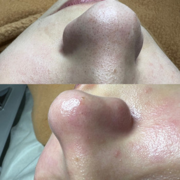 Комбінована чистка обличчя
                    Косметолог-эстетист Дар’я Винница