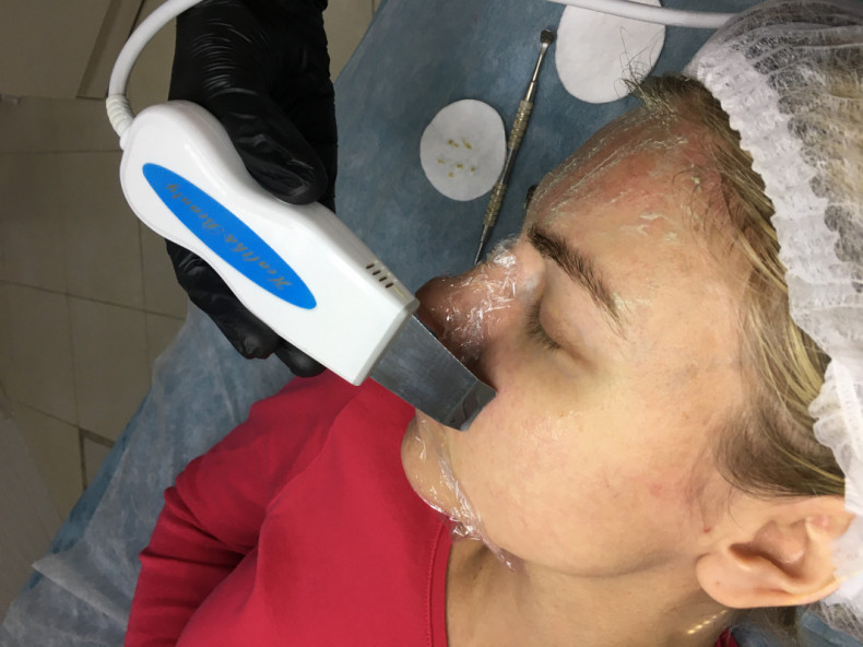 Чистка лица ультразвуком .
 #чисткаобличчя, фото - Мастер по пирсингу Татьяна Ананьева