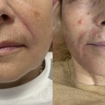 Носогубки ботокс