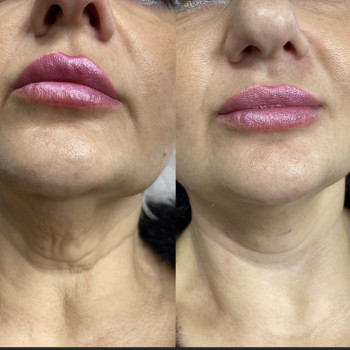 Армирование , ботокс