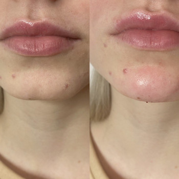 Форма подборобка