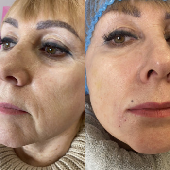 Нижняя треть лица- ботокс, поднятие уголков рта, армирование