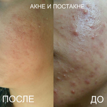 уход за лицом, коррекция морщин, косметология лица