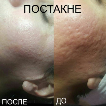 уход за лицом, коррекция морщин, косметология лица