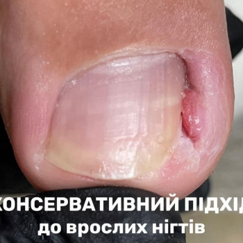 лікування стопи