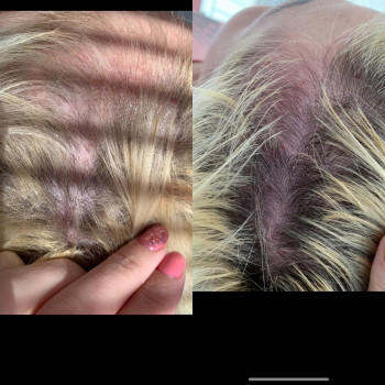 Мезотерапія волосся