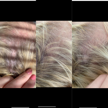 Мезотерапія волосся