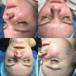 Карбокситерапія Врач-косметолог Христина Тернополь