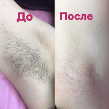 Шугаринг пахви