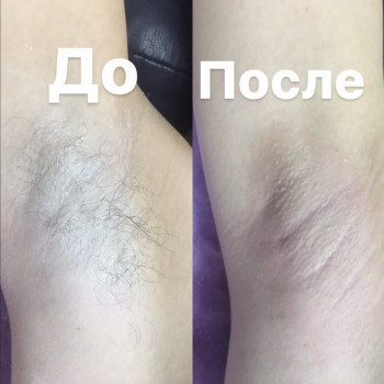 Шугаринг пахви