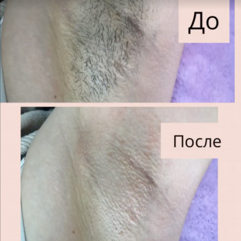 Шугаринг пахви