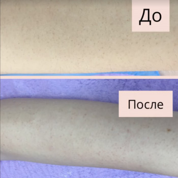 Шугаринг руки повністю