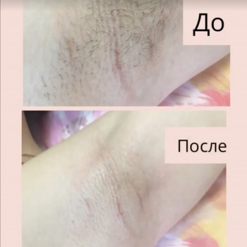 Воскова депіляція, пахви