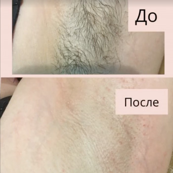 Шугаринг пахви