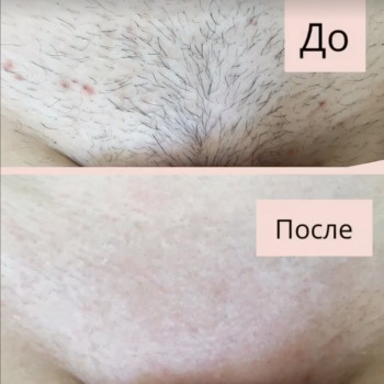 Шугаринг бікіні