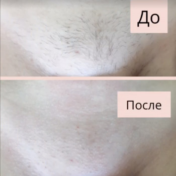 Шугаринг бікіні