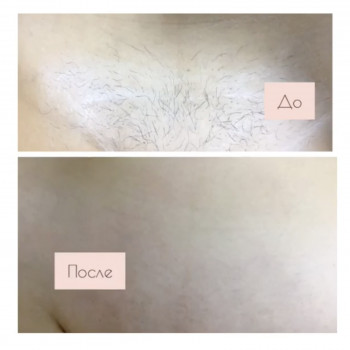 Шугаринг бікіні