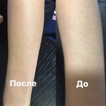 Шугаринг руки повністю