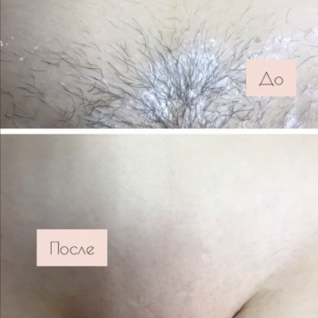 Шугаринг бікіні