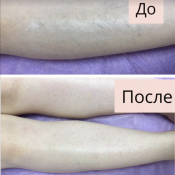 Шугаринг ноги повністю