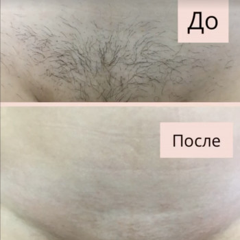 Шугаринг бікіні