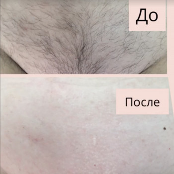 Шугаринг бікіні