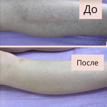 Шугаринг руки повністю