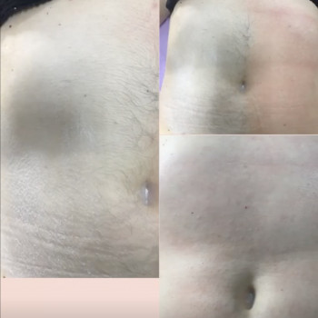 Шугаринг живота