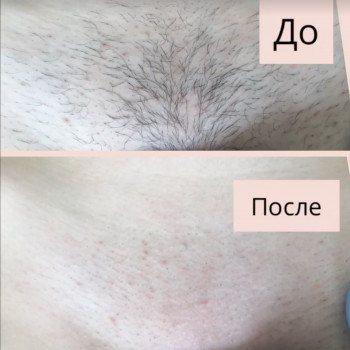 Шугаринг бікіні