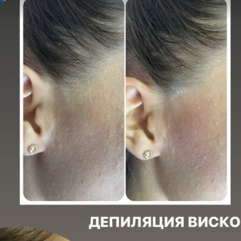 Воскова депіляція скронь