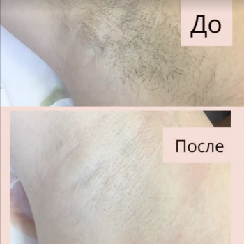 Шугаринг пахв