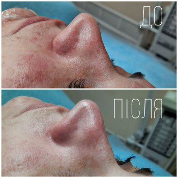 Комбінована чистка обличчя