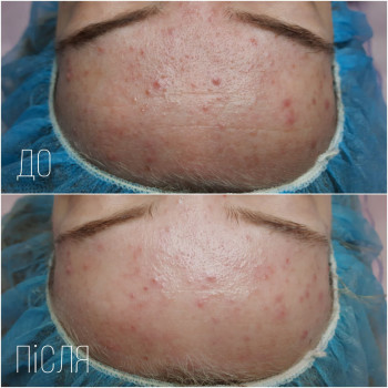 Механічна чистка обличчя