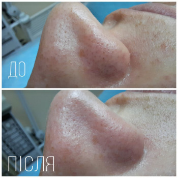 Механічна чистка обличчя