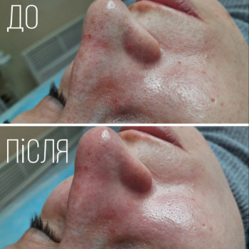 Комбінована чистка обличчя