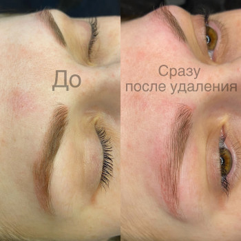 Лазерное удаление татуажа бровей 
До и После процедуры

 