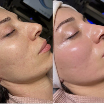 Пилинг Biorepeelcl3 
Процедуру можно проводить летом 
Без ре