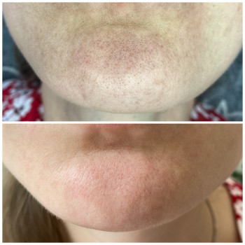 Чистка лица ZO Obagi, Hydropeptide
                    Косметолог Юлия Київ