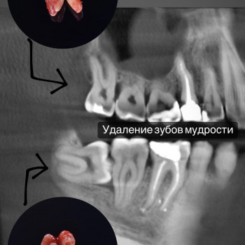 Видалення, фото - стоматолог Вепа Джумаев